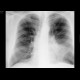 Lung tumour, adjacent to the left hilum: X-ray - Plain radiograph